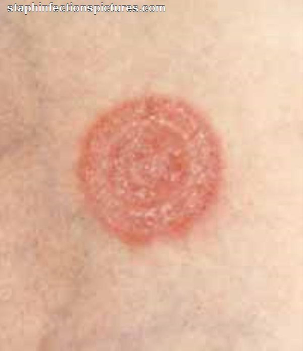 How Do You Get Ringworm - Can You Get Ringworm If Unclean