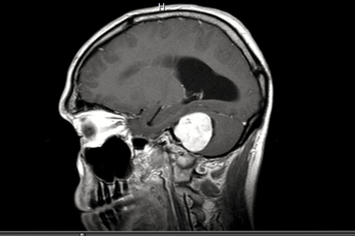 My husband's brain tumor was an acoustic neuroma, also called a vestibular schwannoma. It was located behind his left ear on the nerve that controls the sense of balance.