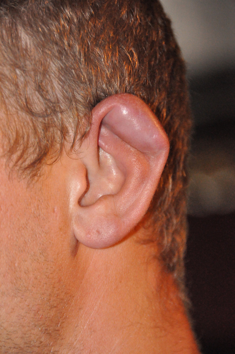 How To Treat And Prevent Cauliflower Ear