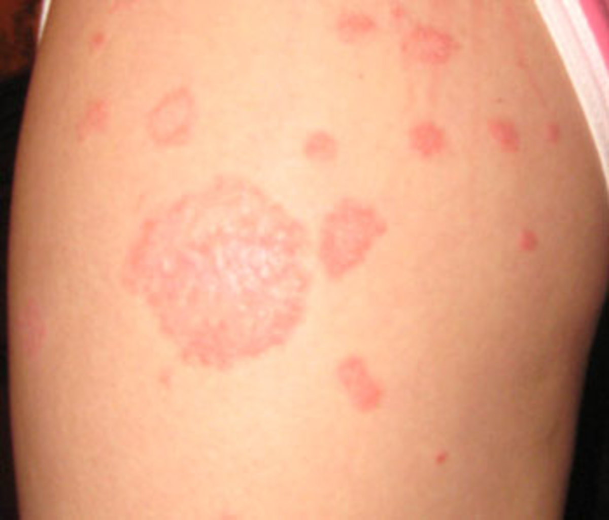 Red Patches on Skin; Causes, Symptoms & Treatment