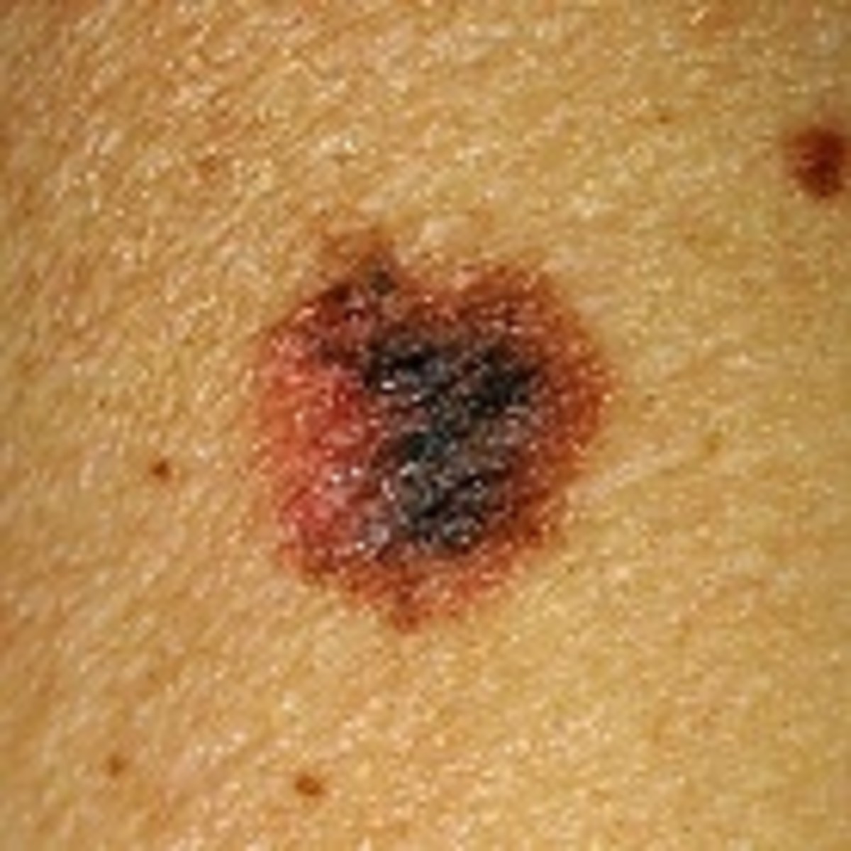 My Melanoma Scare A Personal Story With Some Tips On Preventing And Spotting Skin Cancer Hubpages