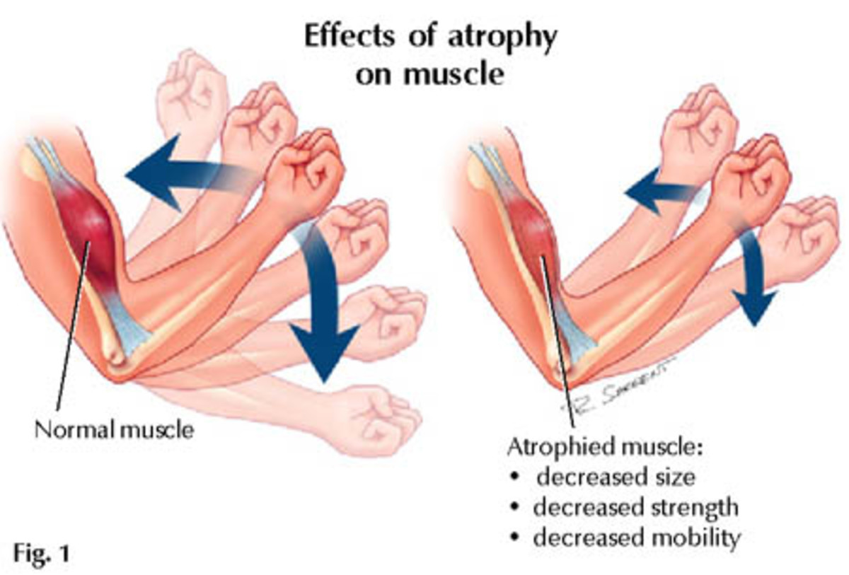 muscle-atrophy