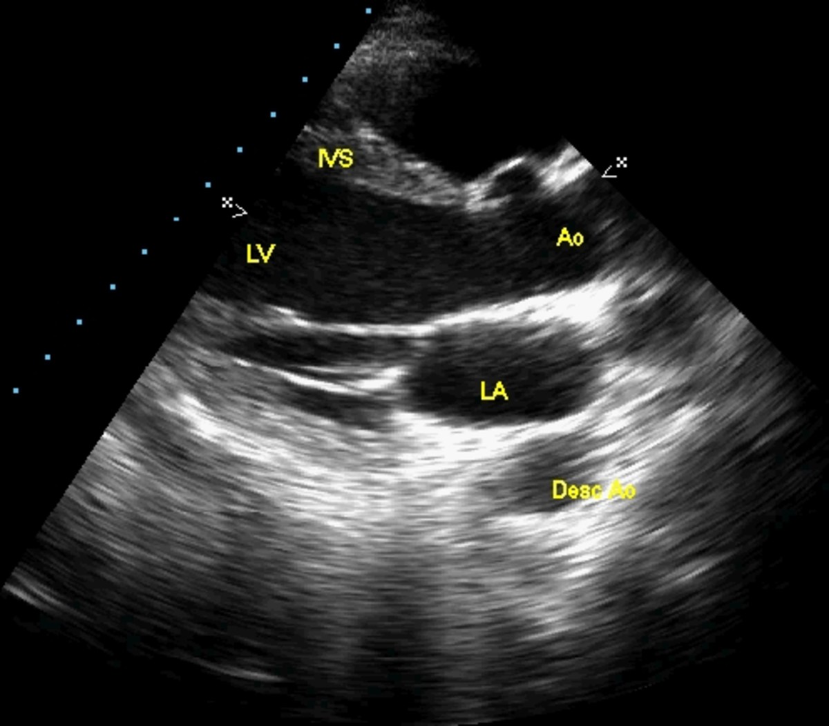 IVS - Interventricular Septum, LV - Left Ventricle, AO - Aorta, LA - Left Atrium, DAO - Descending Aorta