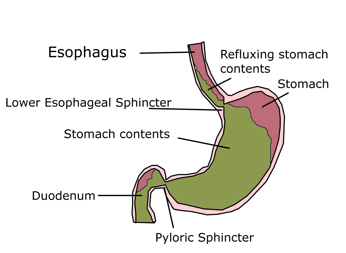 Progesterone causes the lower esophageal sphincter to relax, allowing stomach contents to reflux into the esophagus.