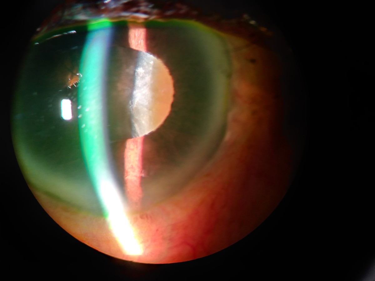 A hypermature cataract. Notice the brownish color on the right side of the white beam of light inside the pupil. This is called brunescence.