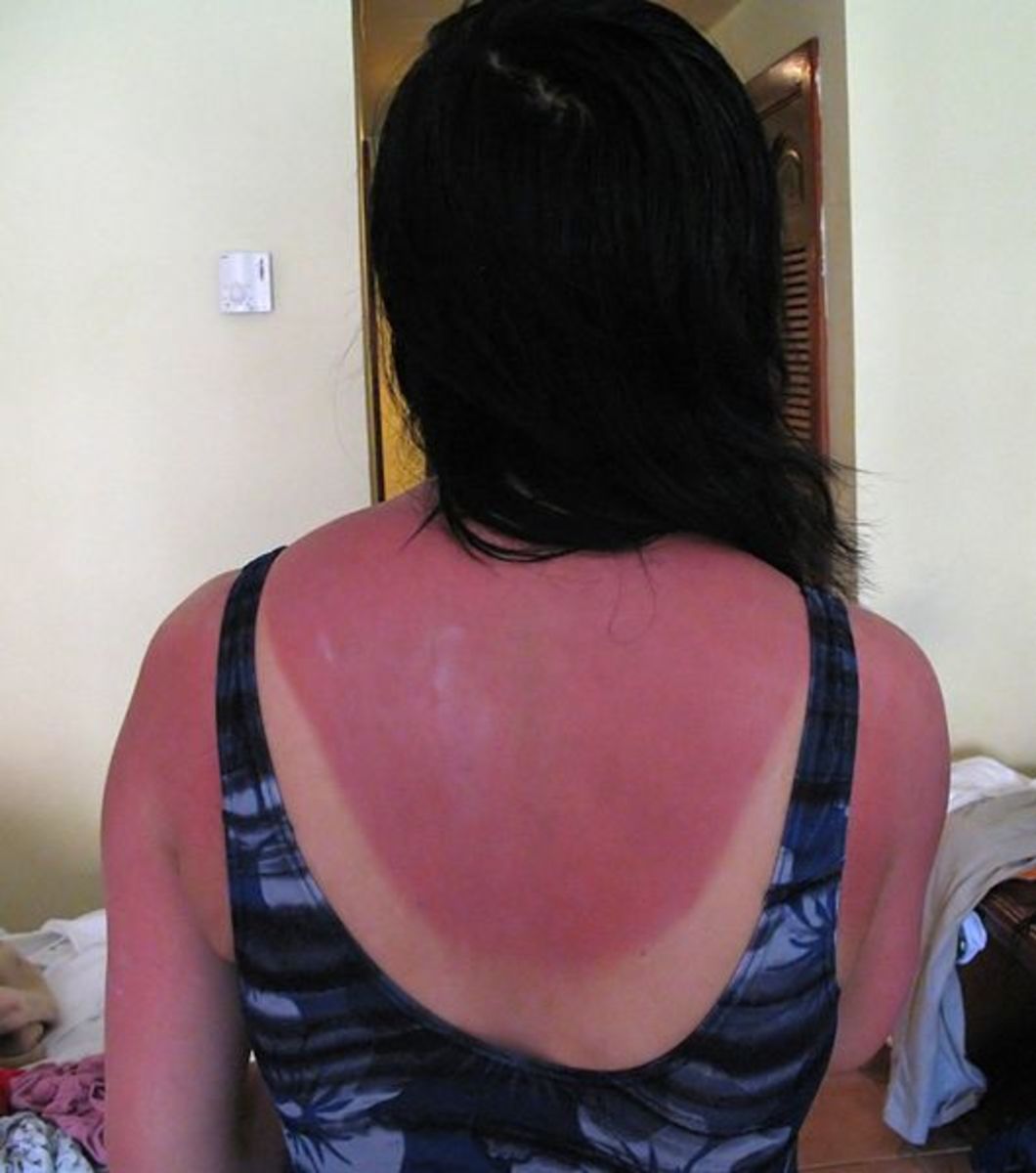 11 Home Remedies to Get Relief from Sunburn and Suntan Naturally