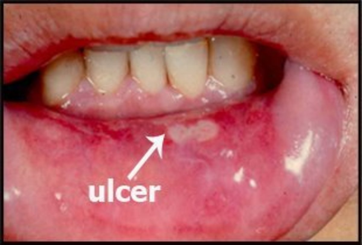 Natural Cures for Mouth Ulcers