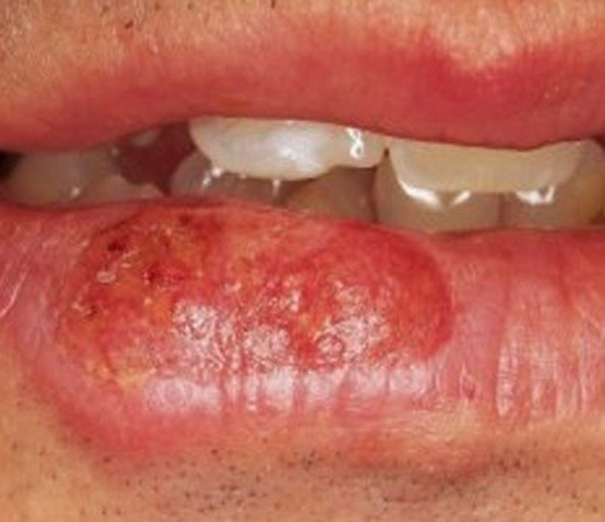 Lip Cancer Pictures Causes Symptoms. 