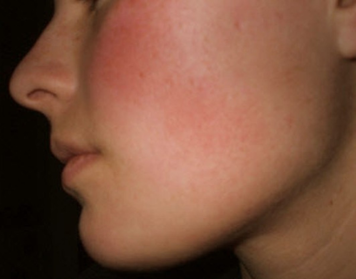 Rash on Face - Treatment, Causes, Pictures