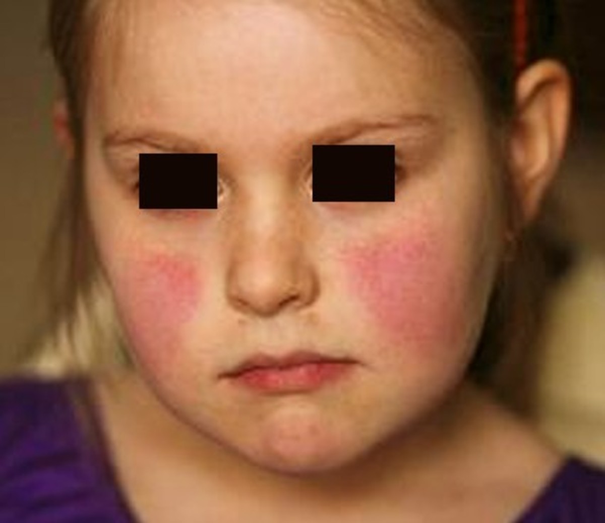 Rash On Face Treatment Causes Pictures HubPages