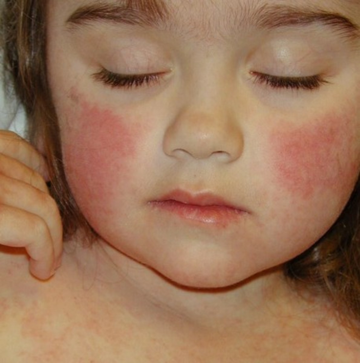 A Visual Guide To Viral Rashes Viral Rash Rash On Face Skin Images