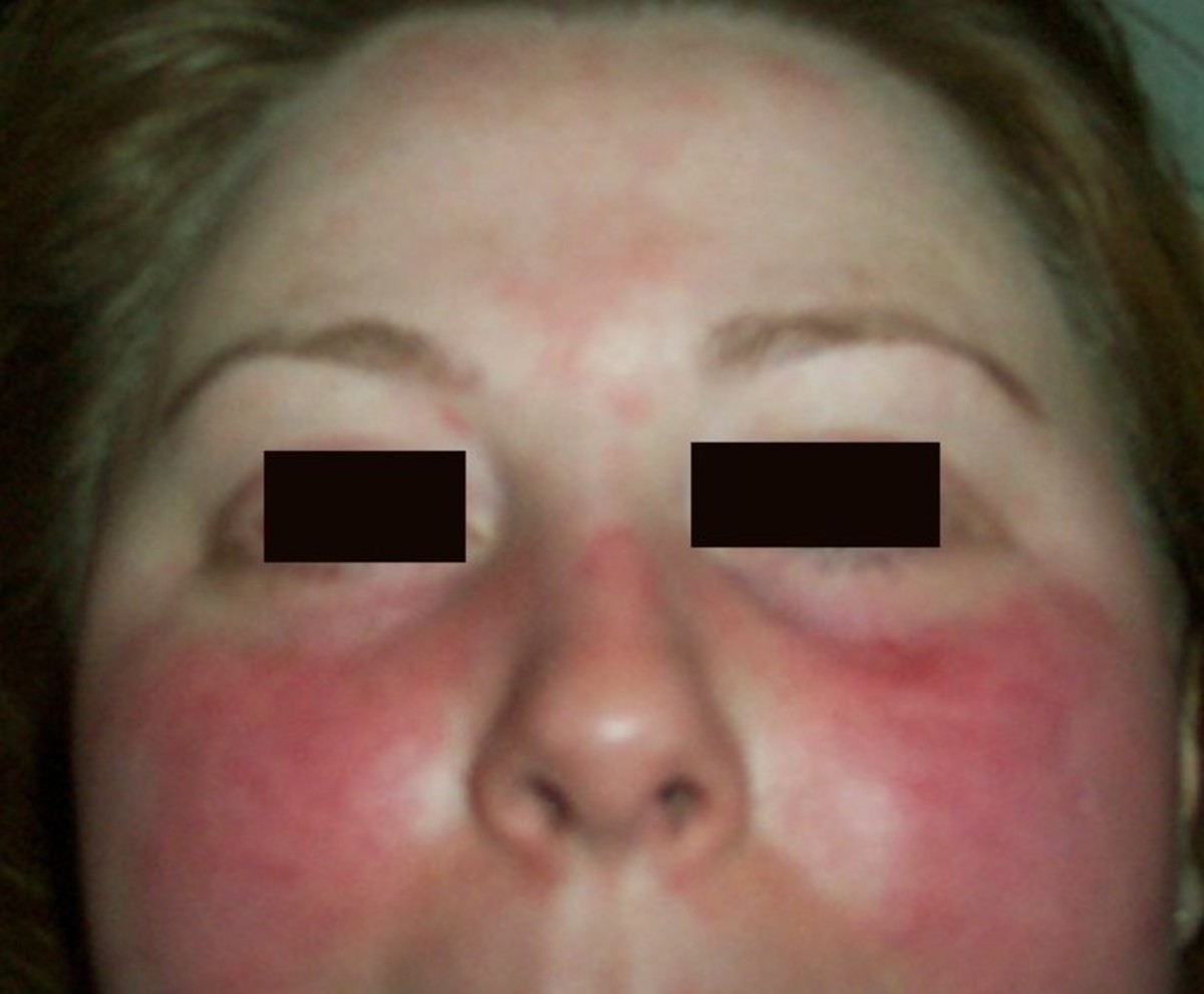 Rash On Face Treatment Causes Pictures HubPages