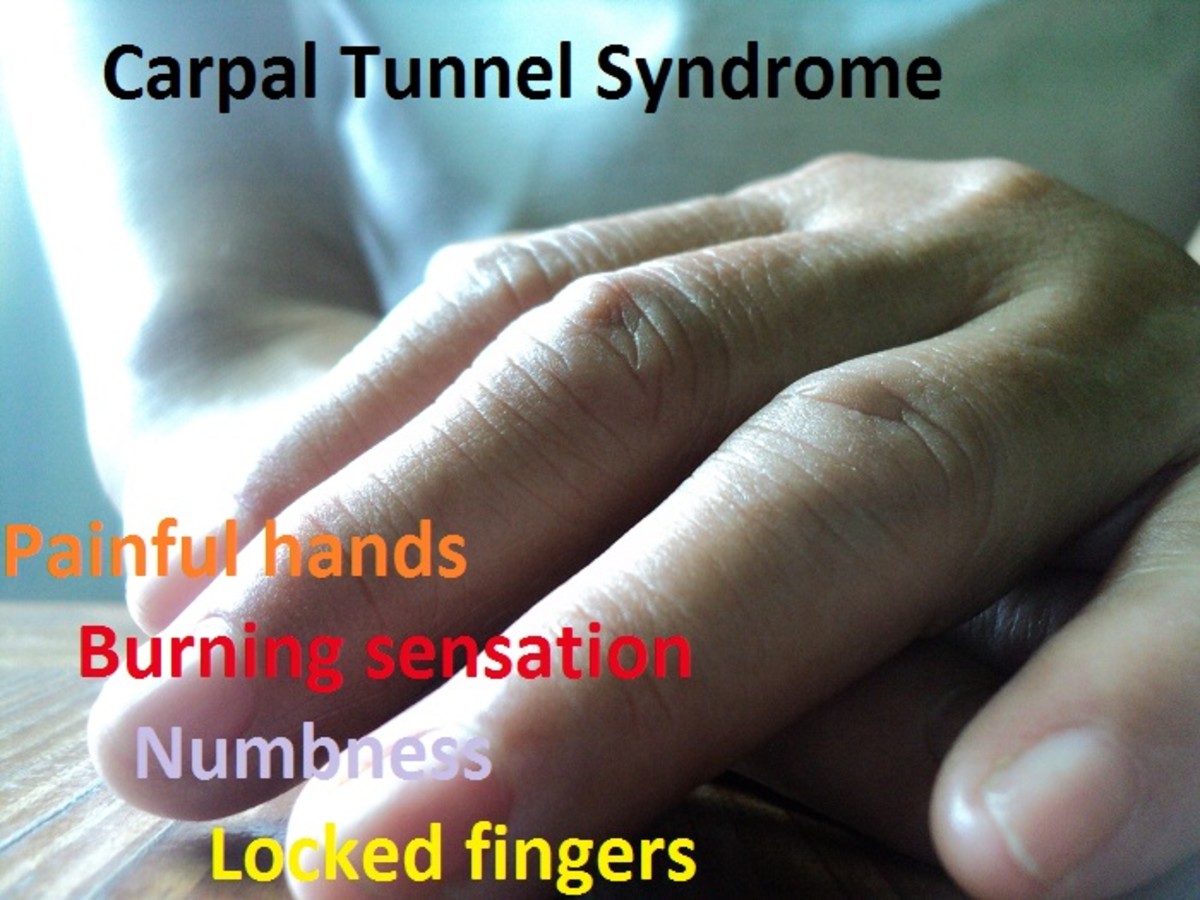 How to Treat Carpal Tunnel Syndrome