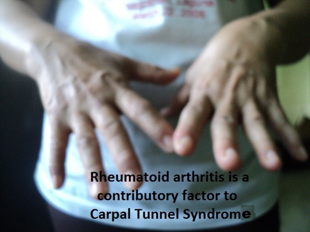 open-carpal-tunnel-release-surgery-not-an-effective-cure-for-painful-hands-carpal-tunnel-syndrome