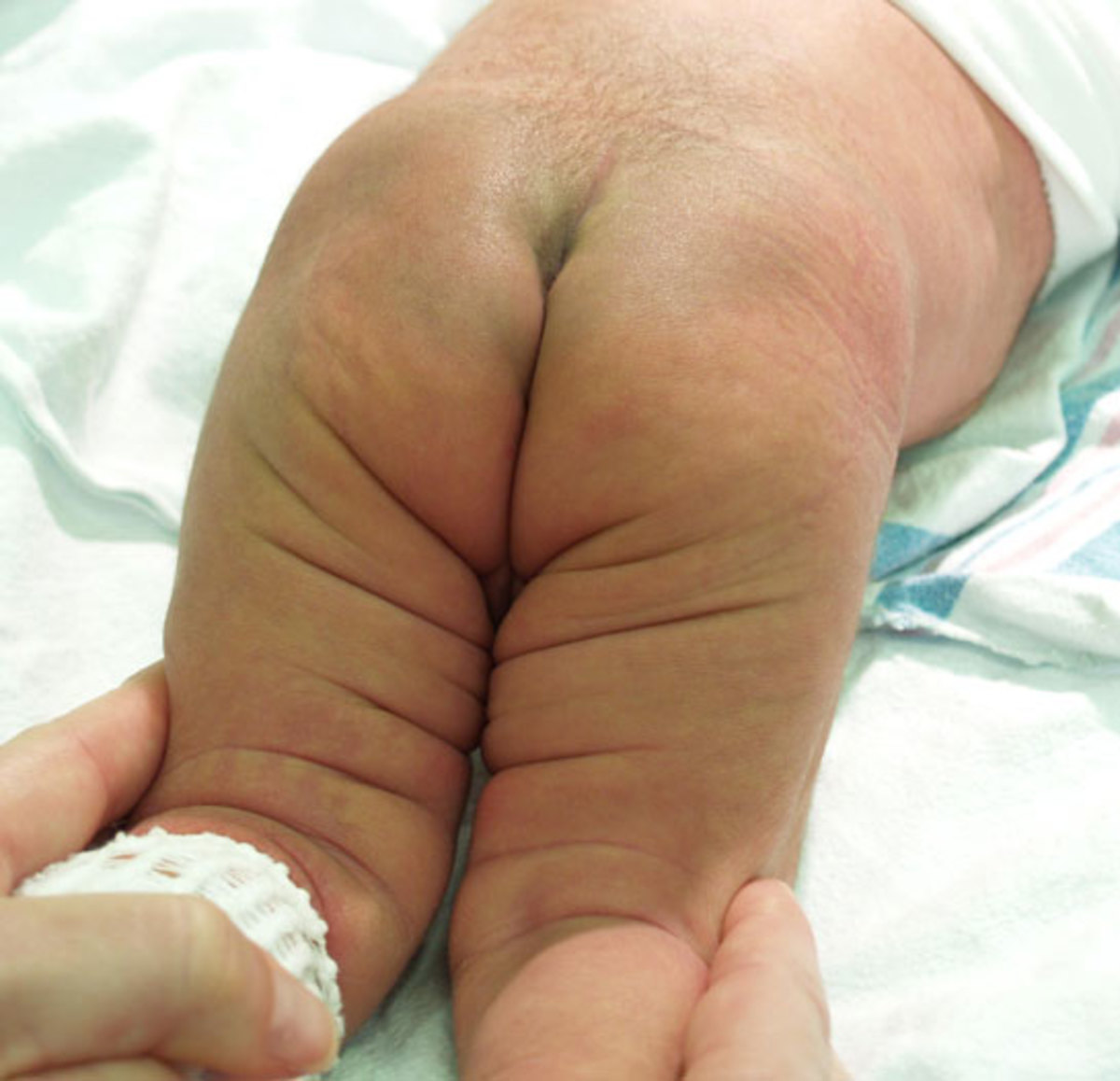  Asymmetry between the major creases in the thighs is a sign of DDH   