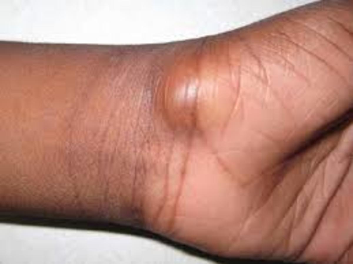 A ganglion cyst underneath the wrist