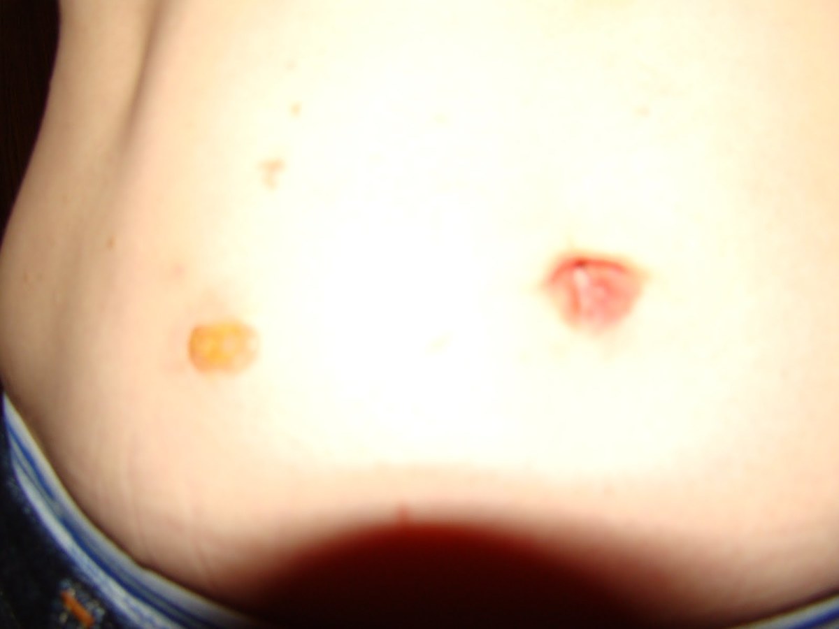 Yeast Infection in Belly Button