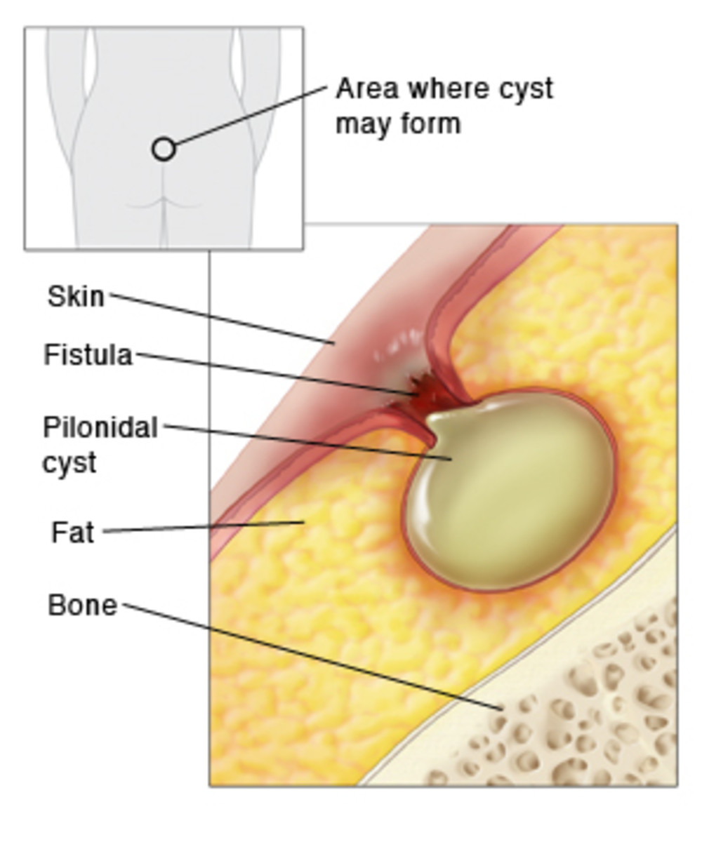 BehindTheKnife on X: Pilonidal Cysts - mundane complaint or sneaky nuanced  problem? Catch @ScottRSteeleMD, @georgoff, and @ShanazHossainMD as they  discuss the management of pilonidal cysts in our latest episode! Use this  handy