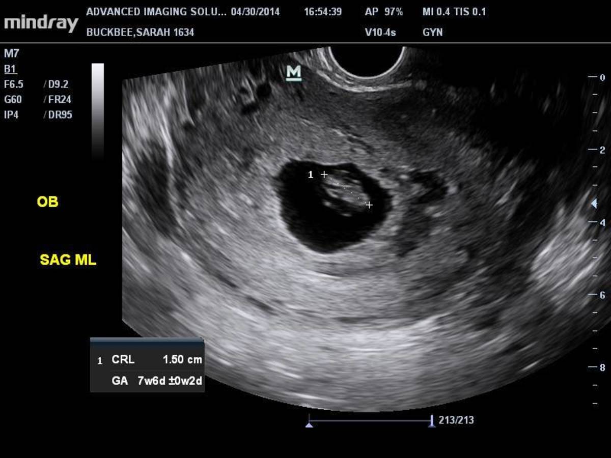 The empty sac on the right side indicates a twin that didn't make it past the embryonic stage. See the blood in the lower half of the sac.
