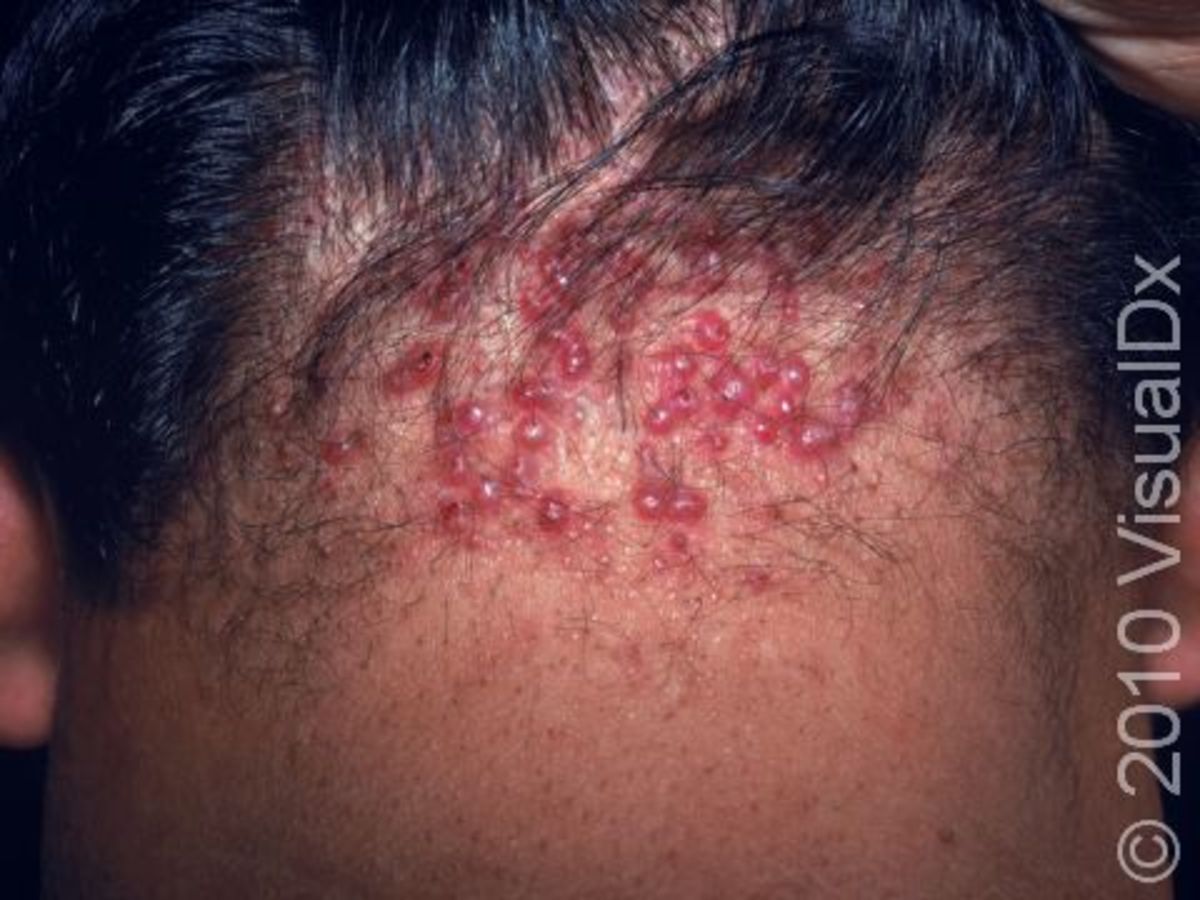 Nasty Bumps On The Back Of Your Head What Are They And How To Get Rid 