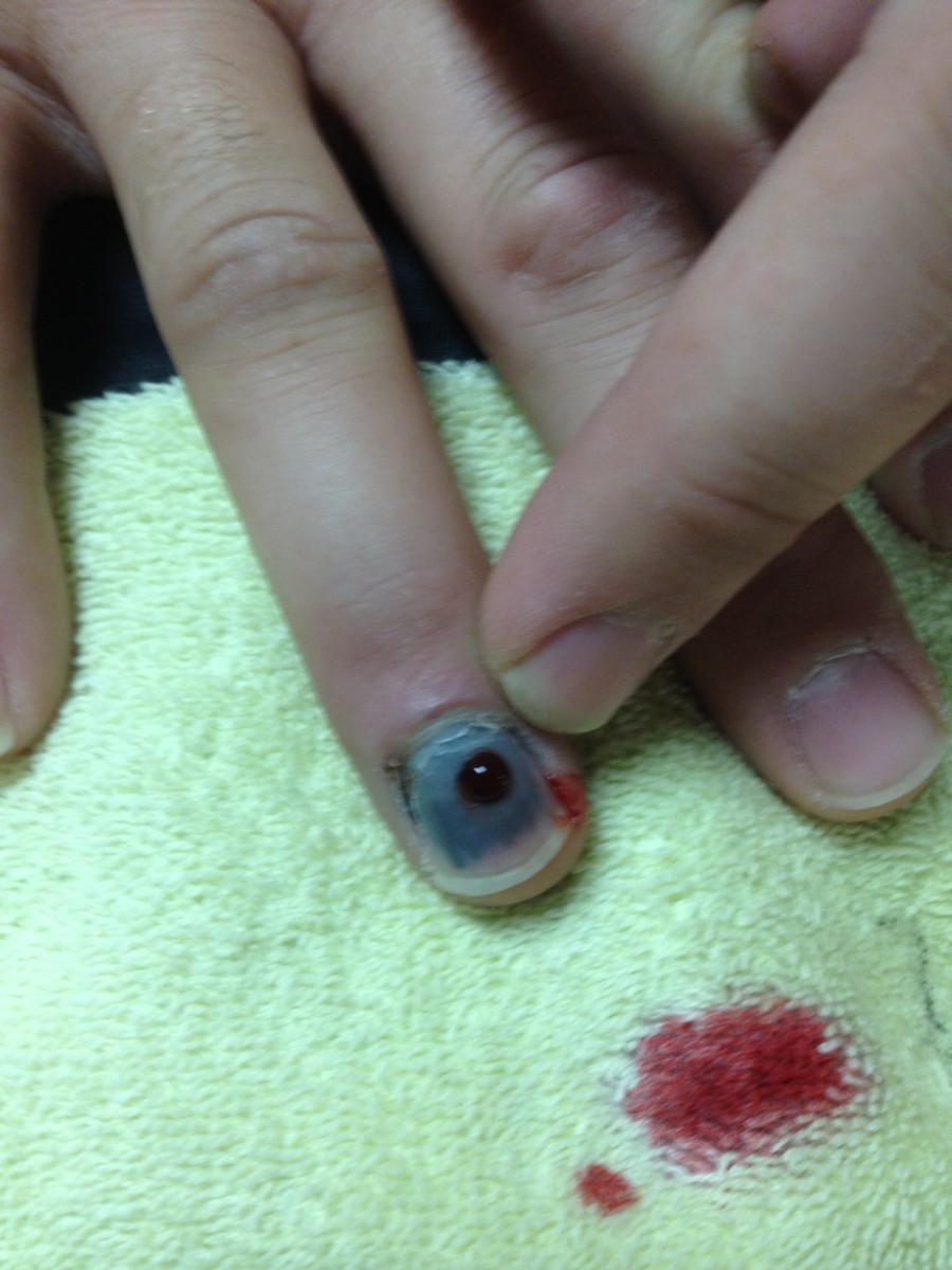 Blood bister under fingernail