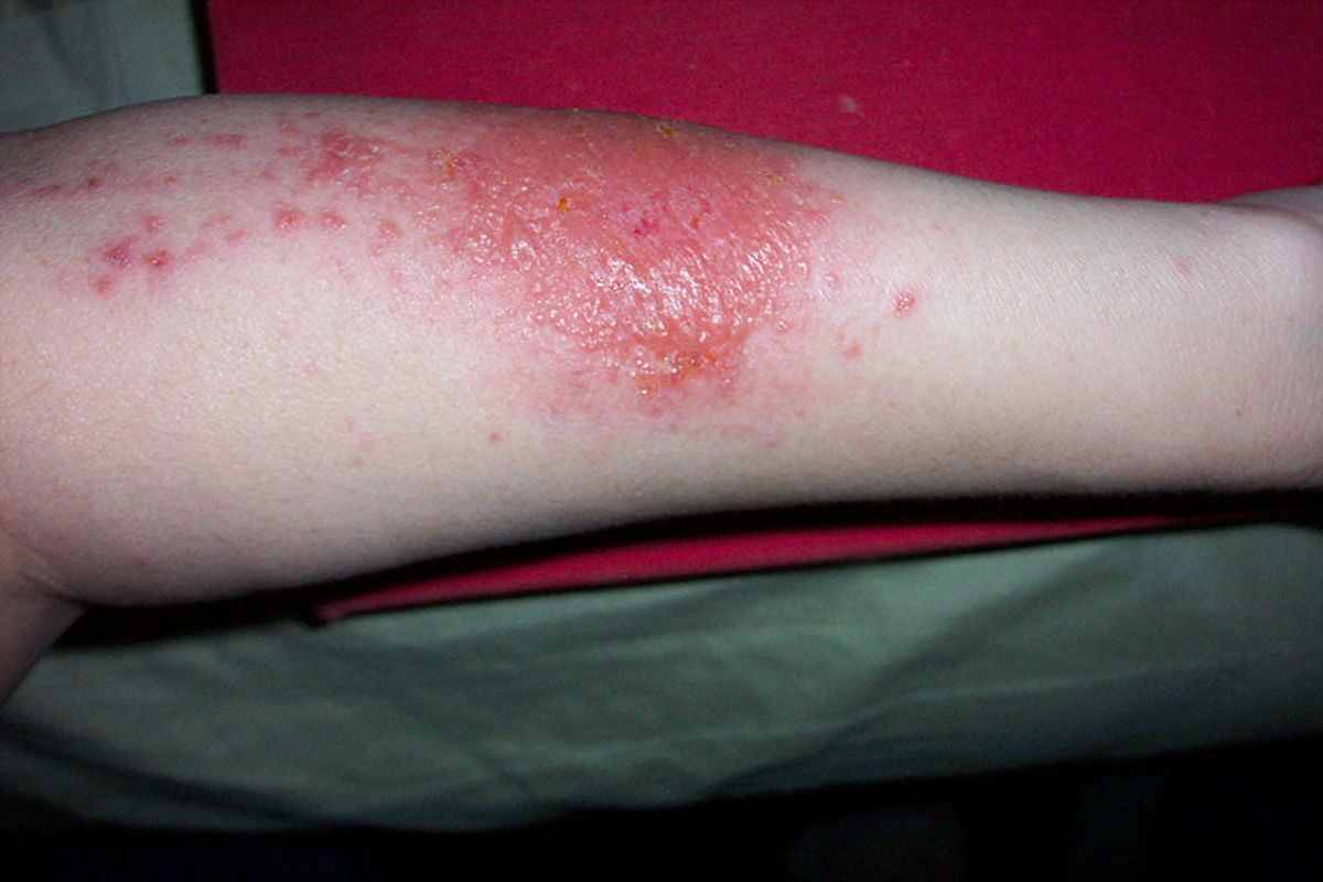 Poison Ivy Rash (also known as Urushiol-induced contact dermatitis)