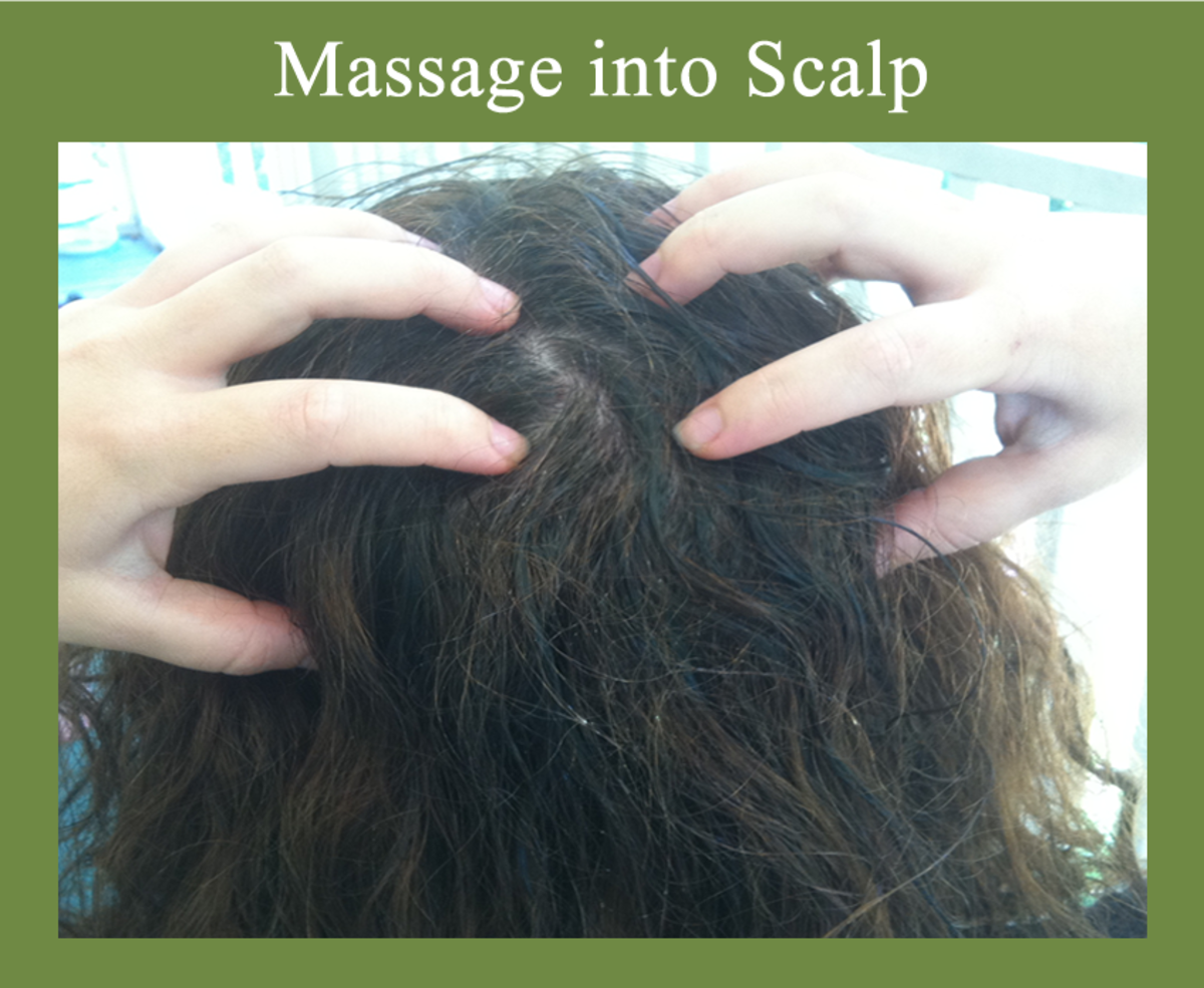 Natural Scalp Psoriasis Treatment With Tea Tree Oil And Olive Oil Hubpages 