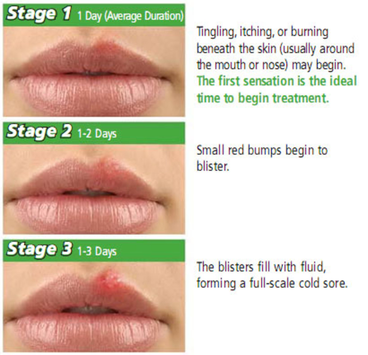 how-do-i-reduce-herpes-breakouts