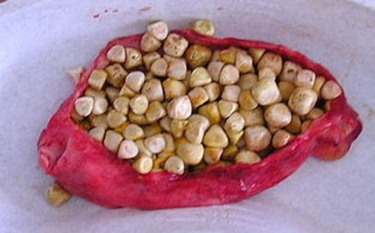 A recently removed gallbladder full of cholesterol stones.