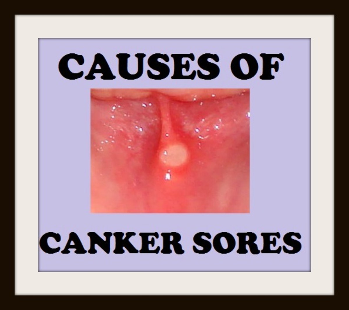 Can sucking dick cause canker sores