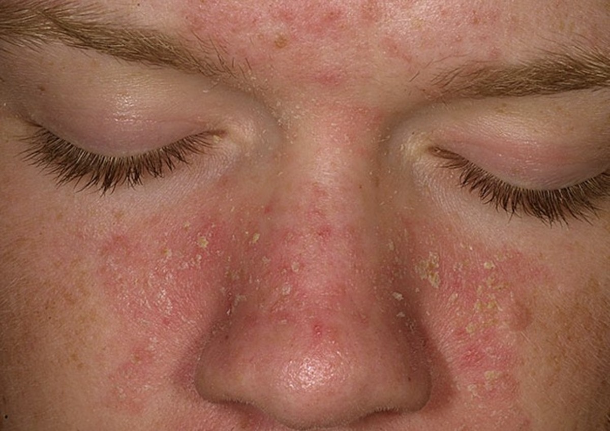 seborrheic-dermatitis-pictures-on-face-scalp-hair-loss-causes-treatment