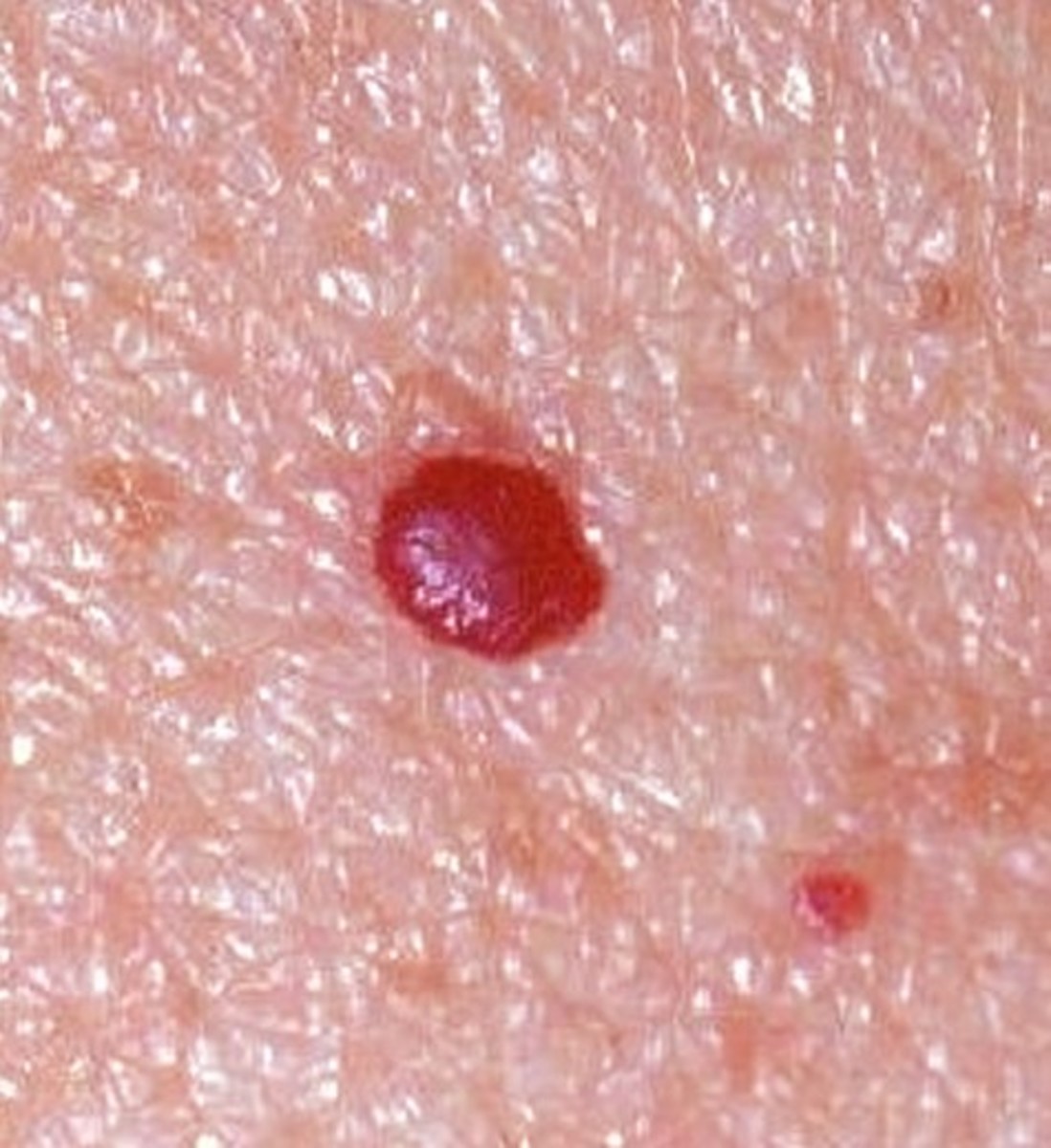 Cherry Angioma On Face Removal At Home At Judy Moody Blog