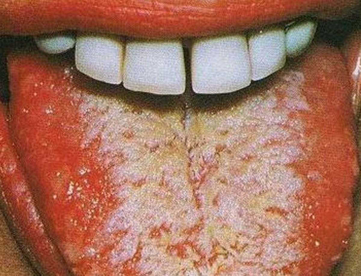 hairy-tongue-black-white-causes-treatment-and-pictures