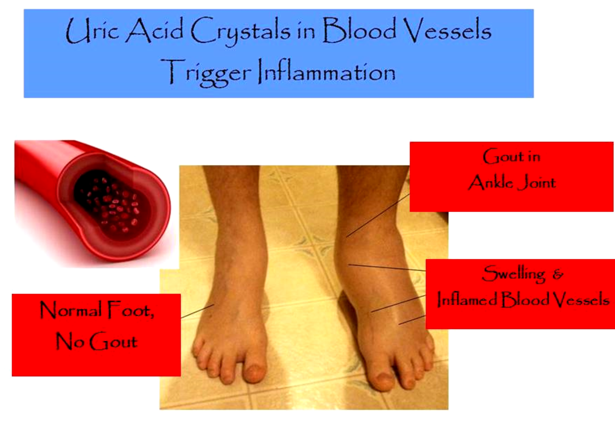 Everything You Ever Wanted to Know About Gout: Causes, Symptoms ...