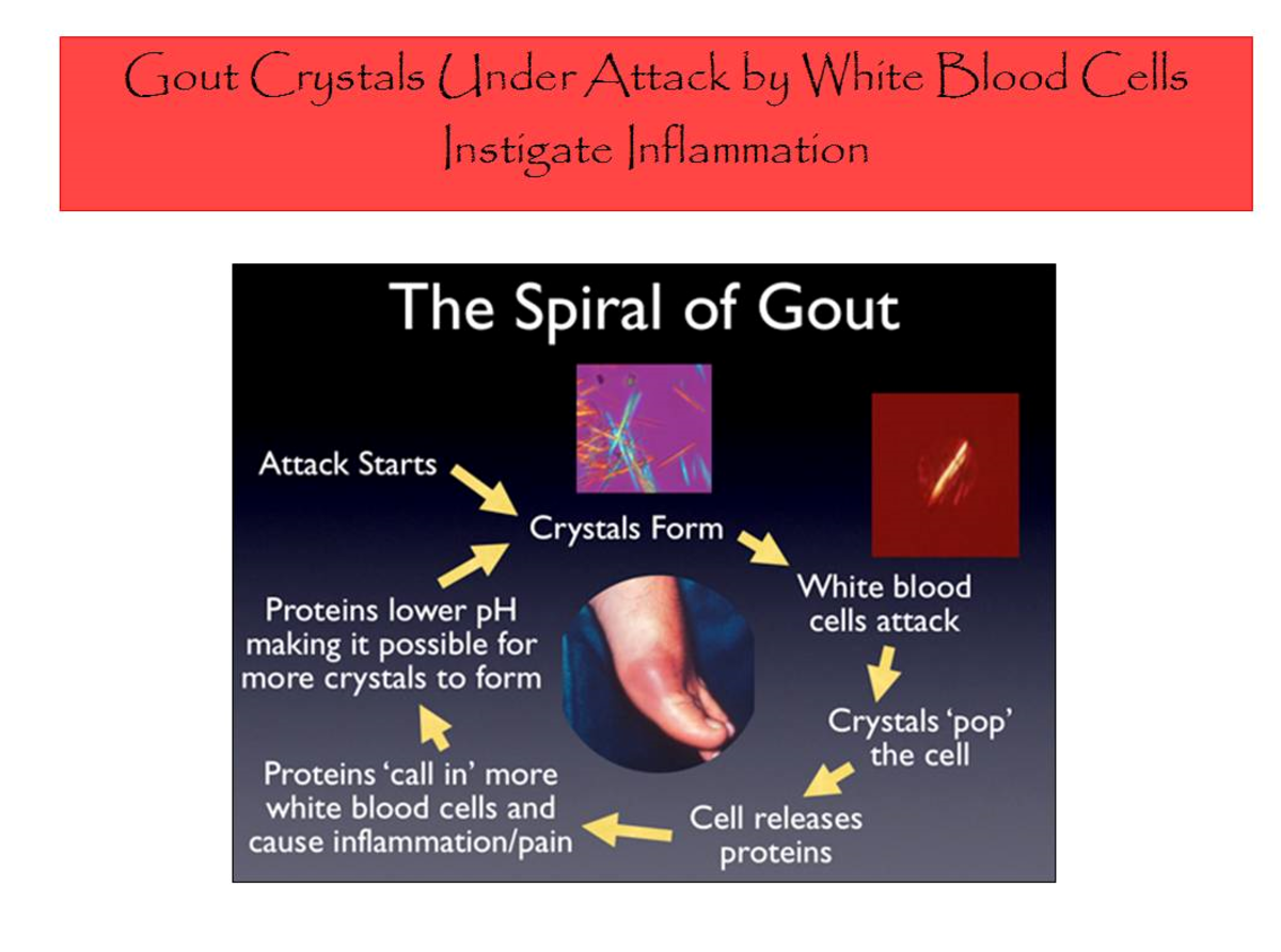 Everything You Ever Wanted to Know About Gout: Causes, Symptoms ...