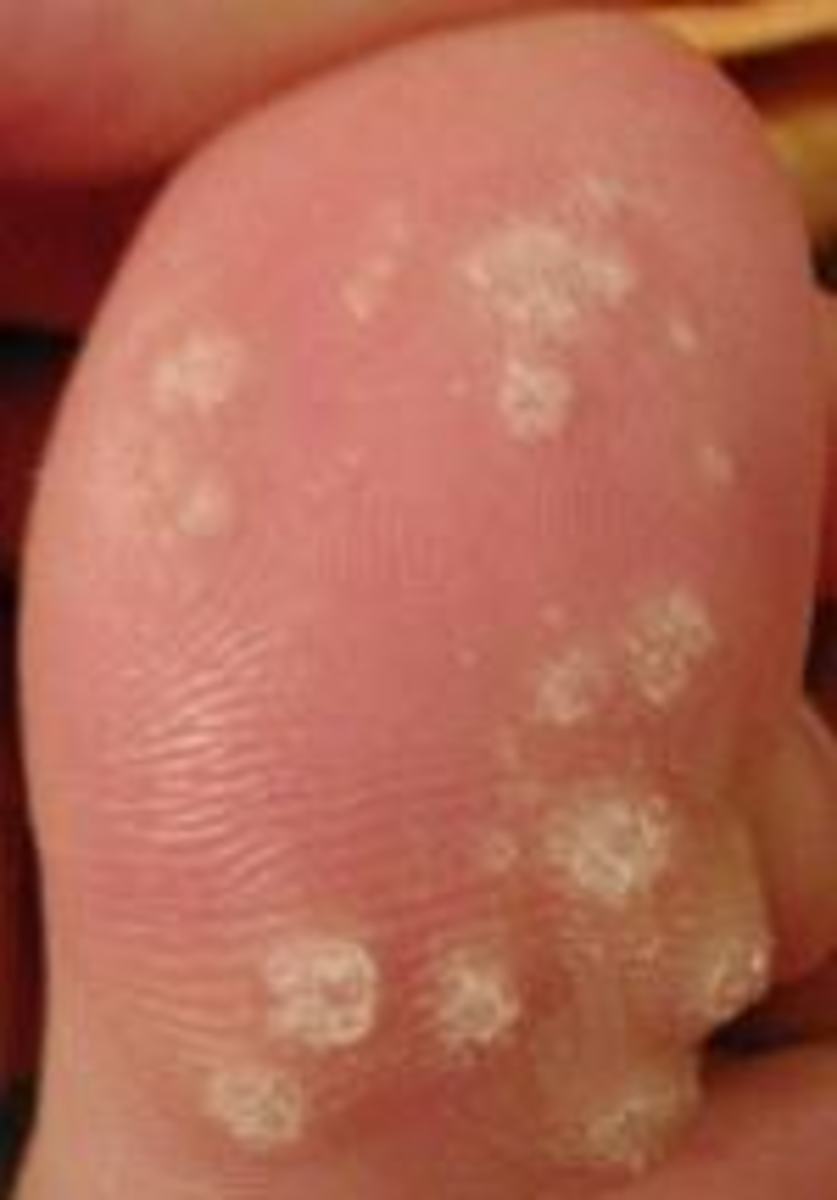 Warts - How To Cure Your Childs Warts The No Pain Way - 5 Gentle Treatments