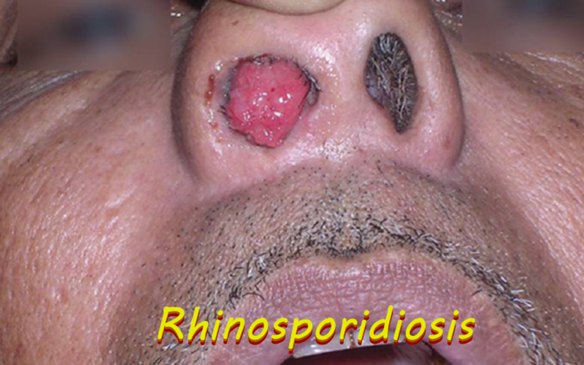 Rhinosporidiosis is a fungal disease caused by an organism called the Rhinosporidium Seeberi.