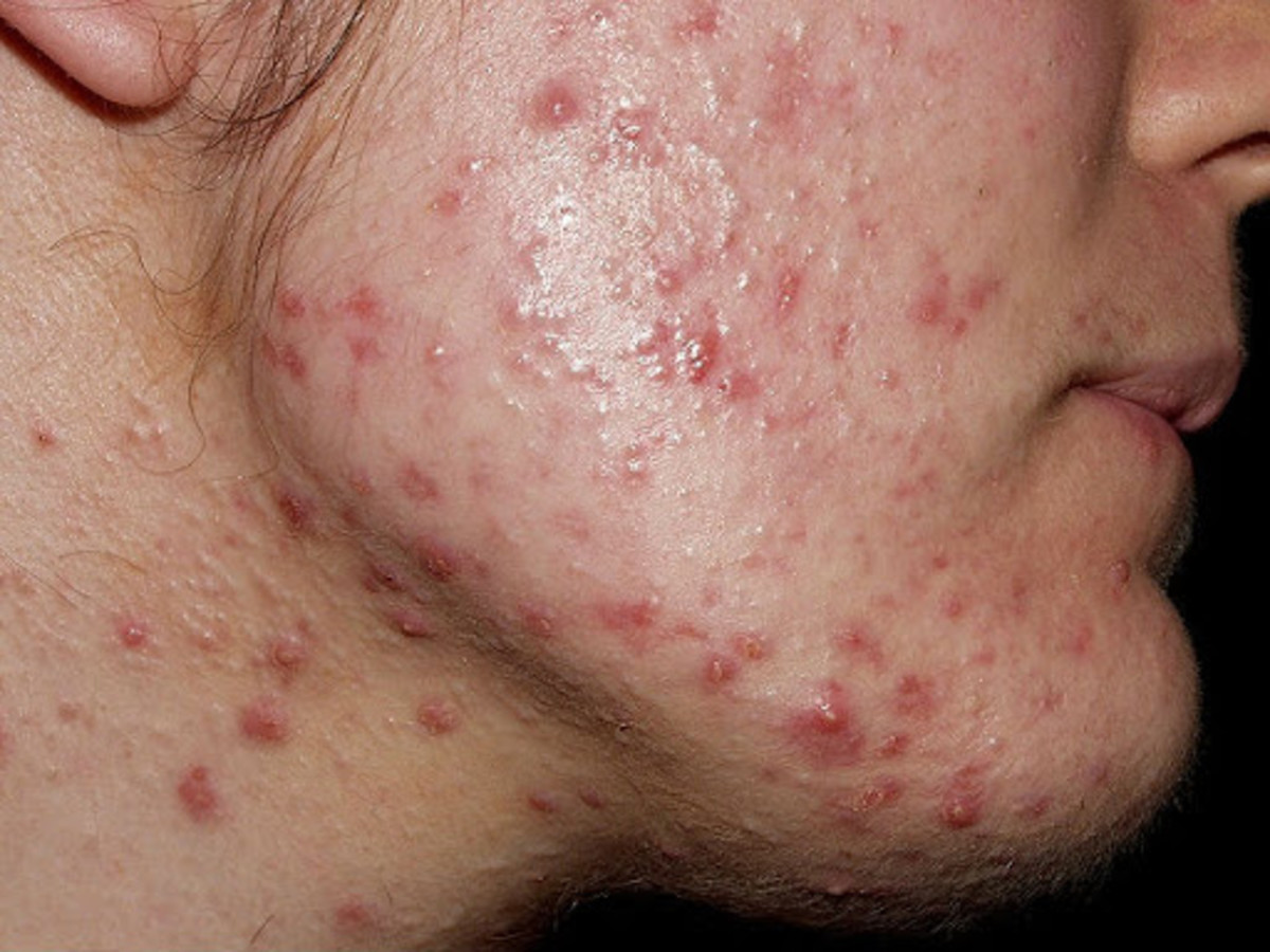 6 Simple Ways to Cure Acne (for Women) Personal Experience!