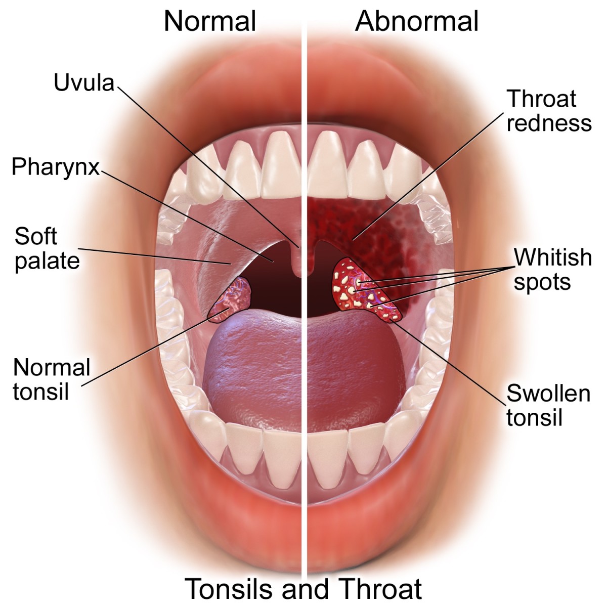 A normal and an infected throat; one cause of white spots on tonsils is group A streptococcus