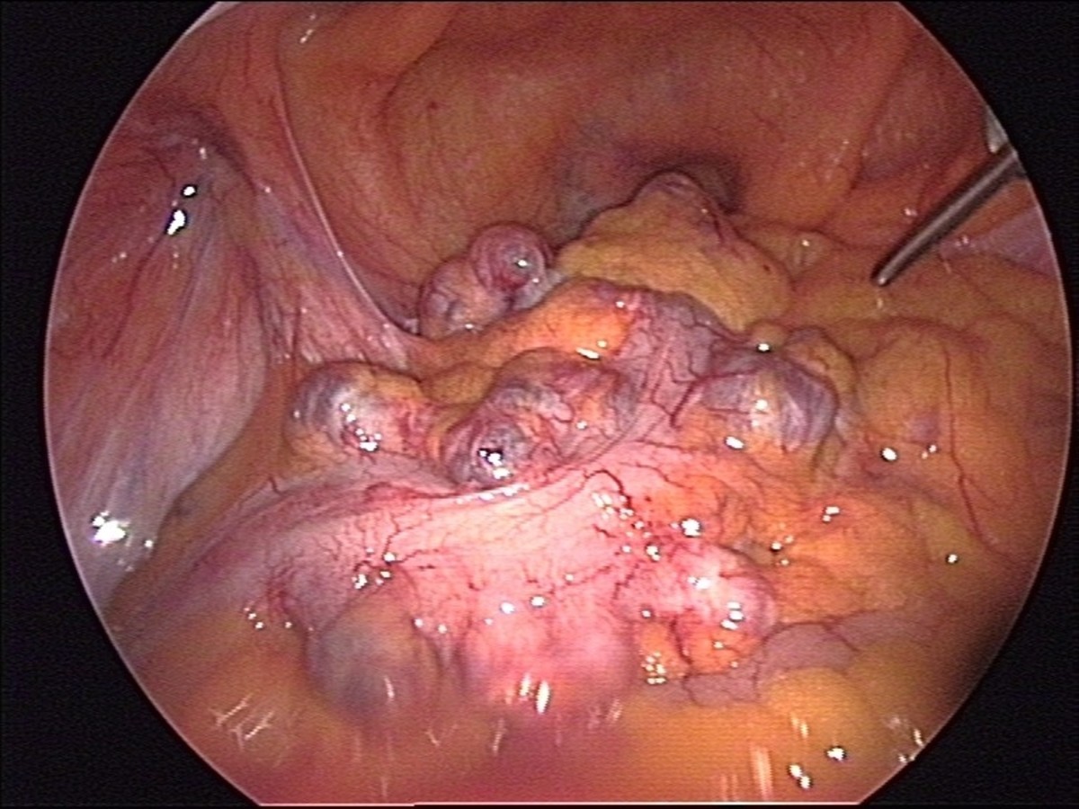 View of diverticula from a laparoscopic operation.