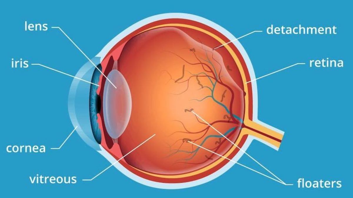 Eye Health: My Experience With a Detached Vitreous - Patient's Lounge