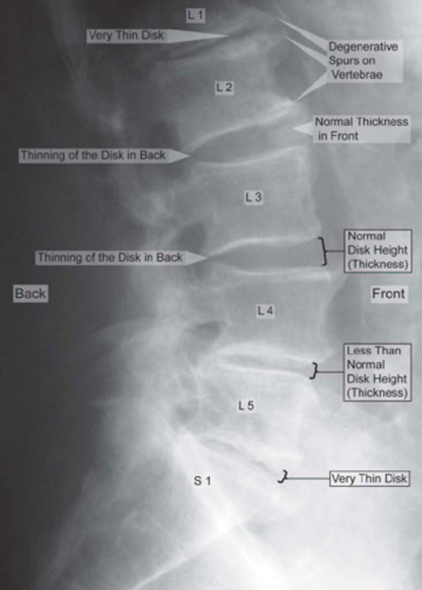 X-ray of the spine showing Degeneration