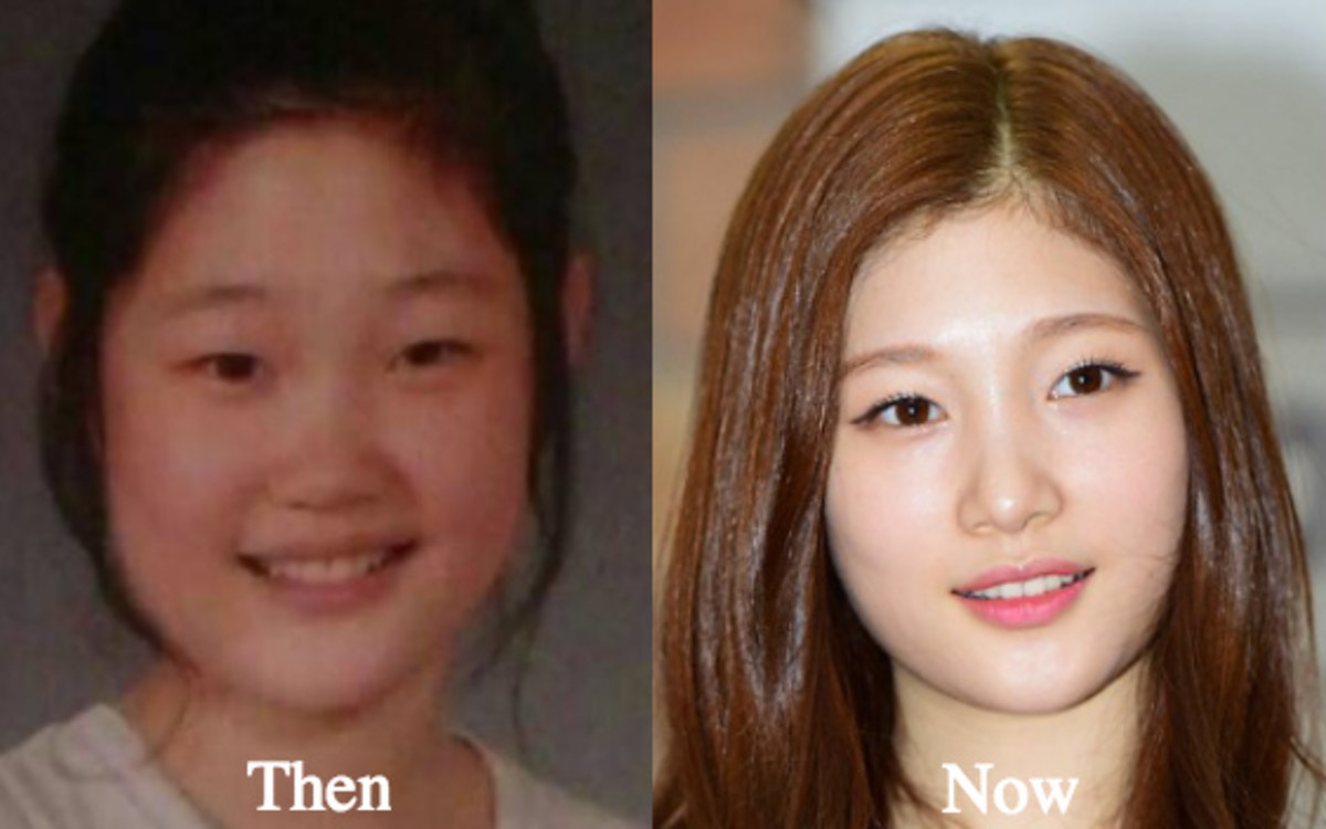 10 Famous Korean Celebrities Who Have Had Plastic Surgery. 