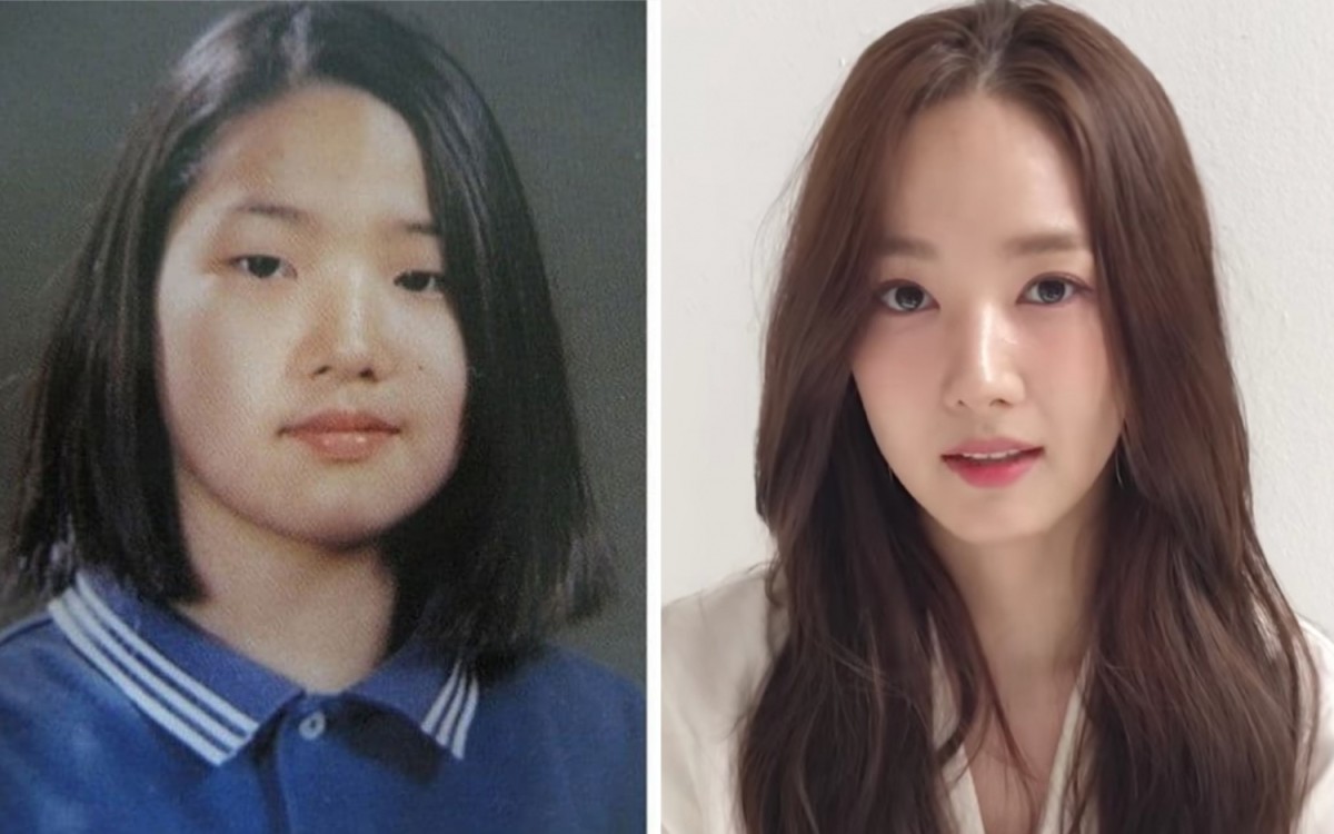 Korean celebs before and after surgery