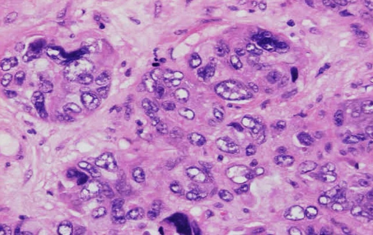Invasive ductal carcinoma with marked nuclear pleomorphism. 