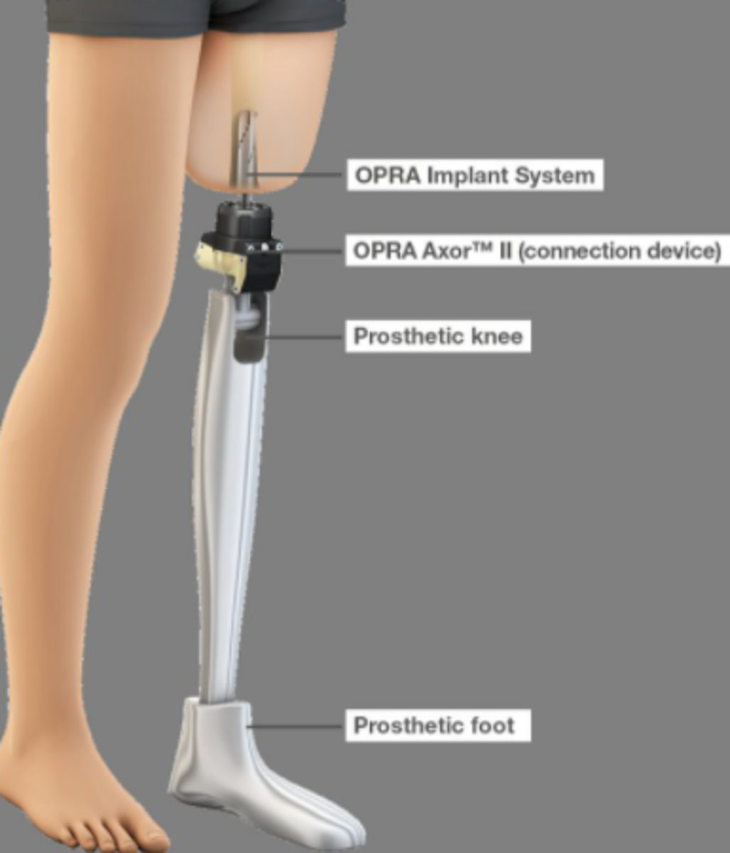 amputation-and-prosthetics