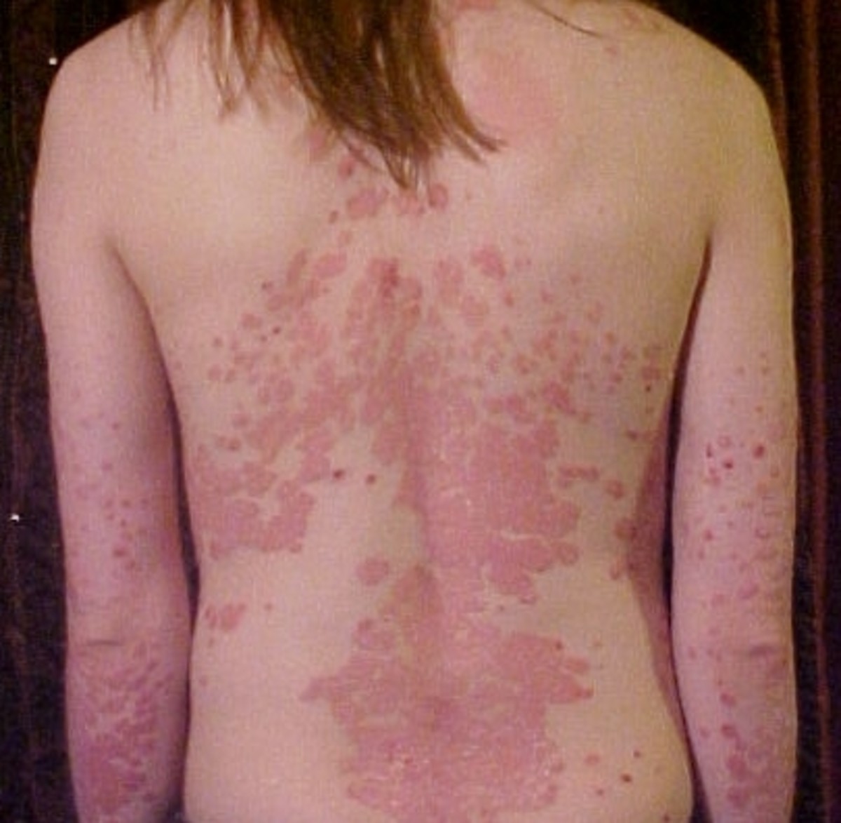 Psoriasis affecting the back