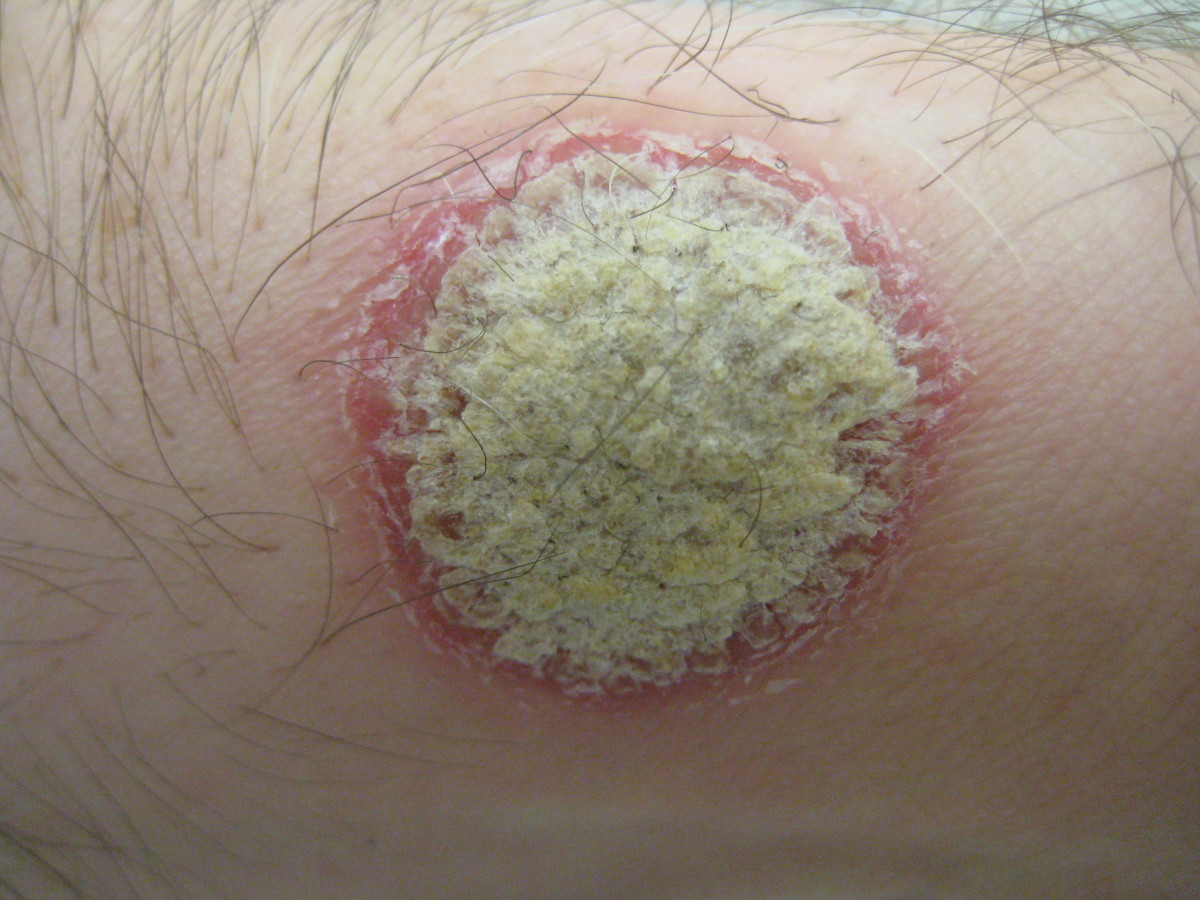 Psoriatic plaque, showing a silvery center surrounded by a reddened border.
