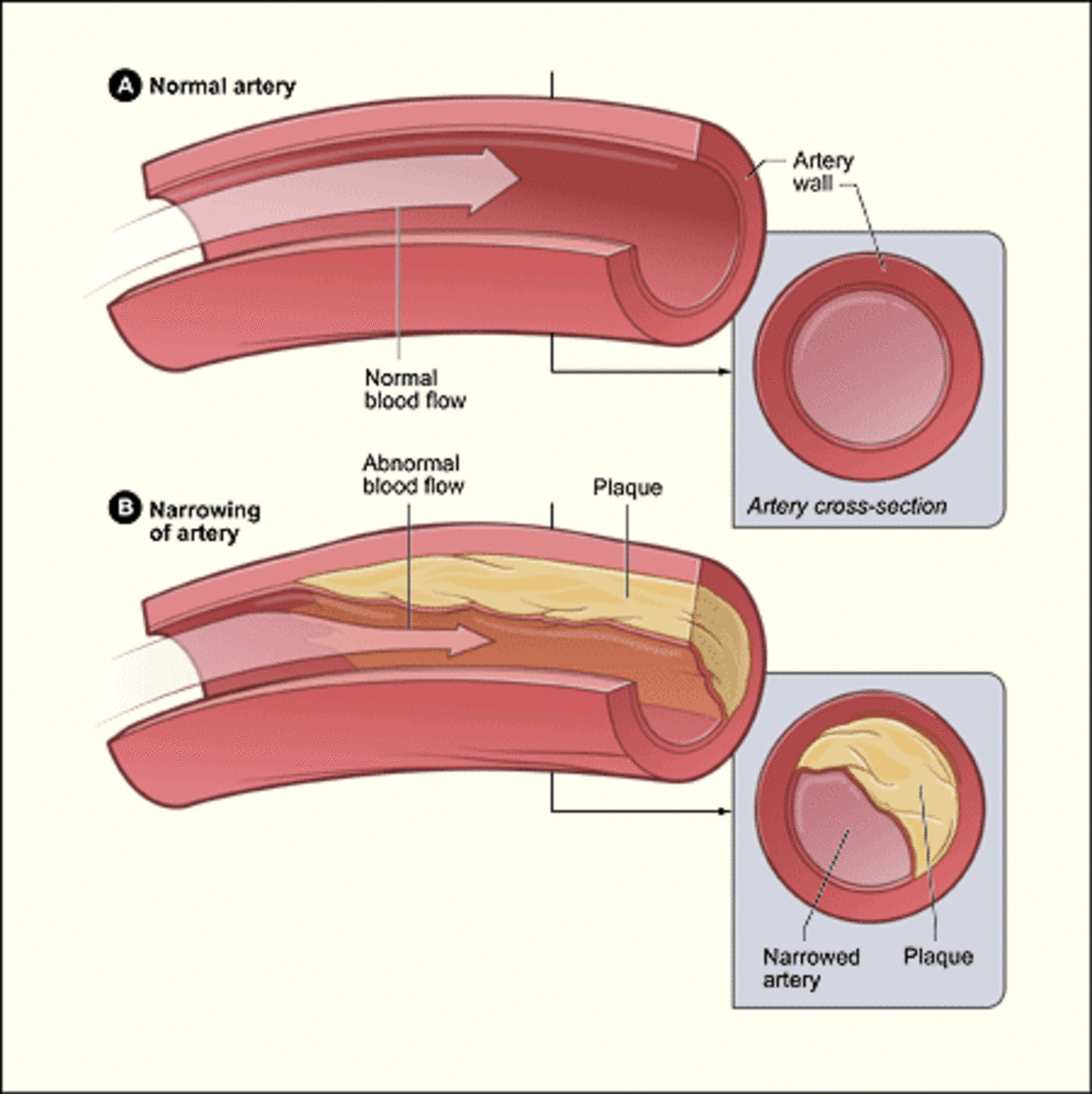 Plaque in coronary arteries