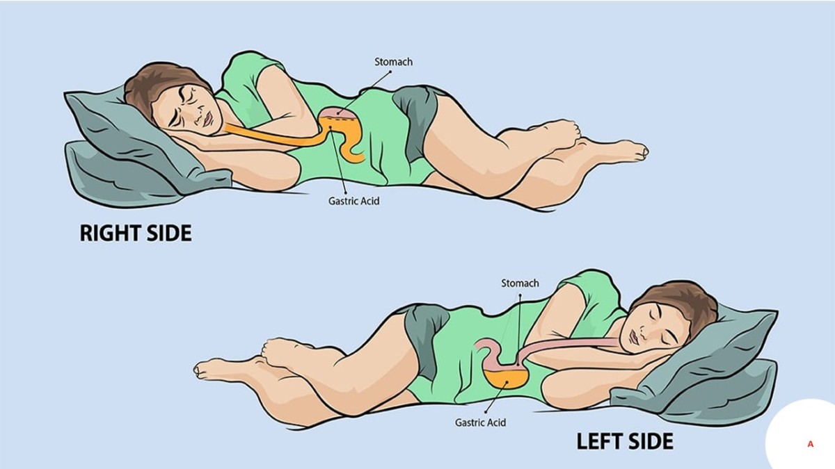 This image shows how acid comes or stays on your esophageal when you sleep on the right side but if you sleep on the left side acid stay on the stomach and not come on the esophageal.